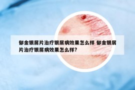 郁金銀屑片治療銀屑病效果怎么樣 郁金銀屑片治療銀屑病效果怎么樣?