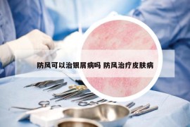 防風(fēng)可以治銀屑病嗎 防風(fēng)治療皮膚病