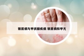 銀屑病與甲狀腺疾病 銀屑病和甲亢