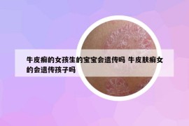 牛皮癬的女孩生的寶寶會(huì)遺傳嗎 牛皮膚癬女的會(huì)遺傳孩子嗎