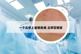 一個丘疹上面銀屑病 丘疹型銀屑