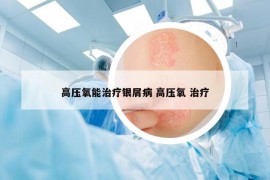 高壓氧能治療銀屑病 高壓氧 治療