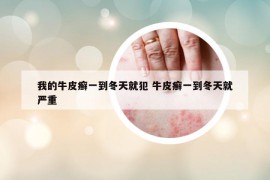 我的牛皮癬一到冬天就犯 牛皮癬一到冬天就嚴重