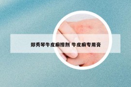 鄭秀琴牛皮癬擦劑 牛皮癬專用膏