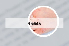牛皮癬成方