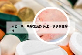 頭上一塊一塊癬怎么辦 頭上一塊塊的像癬一樣