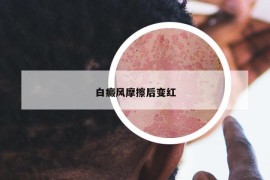 白癜風(fēng)摩擦后變紅
