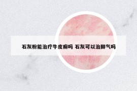 石灰粉能治療牛皮癬嗎 石灰可以治腳氣嗎