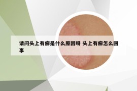 請(qǐng)問頭上有癬是什么原因呀 頭上有癬怎么回事