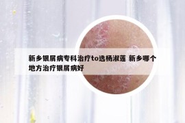 新鄉(xiāng)銀屑病專(zhuān)科治療to選楊淑蓮 新鄉(xiāng)哪個(gè)地方治療銀屑病好