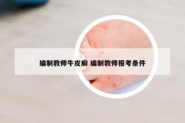 編制教師牛皮癬 編制教師報(bào)考條件