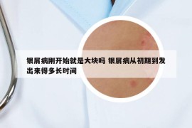 銀屑病剛開(kāi)始就是大塊嗎 銀屑病從初期到發(fā)出來(lái)得多長(zhǎng)時(shí)間