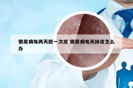 銀屑病每兩天脫一次皮 銀屑病每天掉皮怎么辦