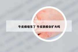 牛皮癬增生了 牛皮膚癬會擴大嗎