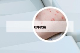 肽牛皮癬