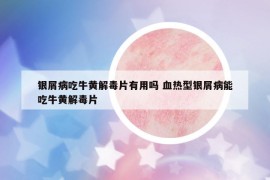 銀屑病吃牛黃解毒片有用嗎 血熱型銀屑病能吃牛黃解毒片