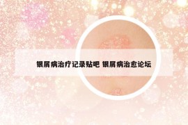 銀屑病治療記錄貼吧 銀屑病治愈論壇