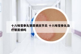 十八味黨參丸銀屑病關(guān)節(jié)炎 十八味黨參丸治療銀屑病嗎