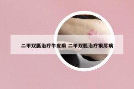 二甲雙胍治療牛皮癬 二甲雙胍治療銀屑病
