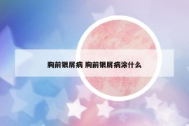 胸前銀屑病 胸前銀屑病涂什么