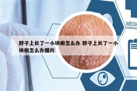 脖子上長了一小塊癬怎么辦 脖子上長了一小塊癬怎么辦圖片