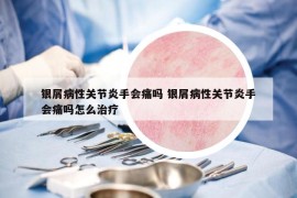 銀屑病性關(guān)節(jié)炎手會痛嗎 銀屑病性關(guān)節(jié)炎手會痛嗎怎么治療