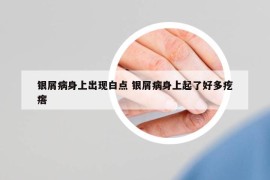 銀屑病身上出現(xiàn)白點 銀屑病身上起了好多疙瘩