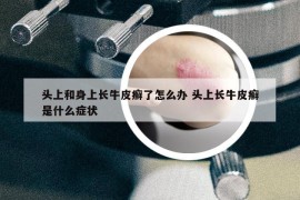 頭上和身上長(zhǎng)牛皮癬了怎么辦 頭上長(zhǎng)牛皮癬是什么癥狀