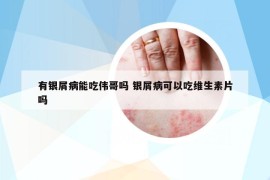 有銀屑病能吃偉哥嗎 銀屑病可以吃維生素片嗎