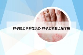 脖子臉上長癬怎么辦 脖子上和臉上起了癬