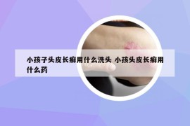 小孩子頭皮長癬用什么洗頭 小孩頭皮長癬用什么藥