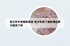 青少年牛皮癬的癥狀 青少年得了銀屑病這輩子就完了嗎