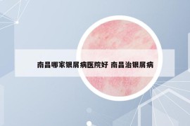 南昌哪家銀屑病醫(yī)院好 南昌治銀屑病