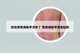 膿包銀屑病指甲沒有了 銀屑病指甲病變起膿