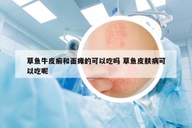草魚牛皮癬和面癱的可以吃嗎 草魚皮膚病可以吃呢