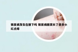 銀屑病發(fā)生在腋下嗎 銀屑病腋窩長了很多小紅點(diǎn)癢