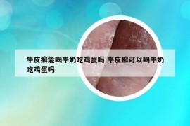 牛皮癬能喝牛奶吃雞蛋嗎 牛皮癬可以喝牛奶吃雞蛋嗎