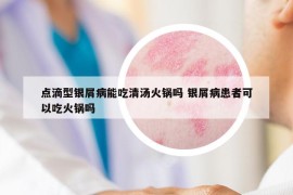 點(diǎn)滴型銀屑病能吃清湯火鍋嗎 銀屑病患者可以吃火鍋嗎