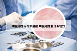 斑蝥泡醋治療銀屑病 斑蝥泡醋有什么功效