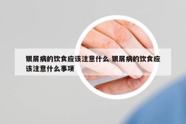 銀屑病的飲食應該注意什么 銀屑病的飲食應該注意什么事項