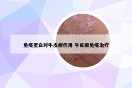 免疫蛋白對(duì)牛皮癬作用 牛皮廨免疫治療