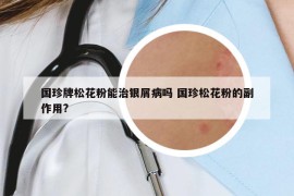 國珍牌松花粉能治銀屑病嗎 國珍松花粉的副作用?