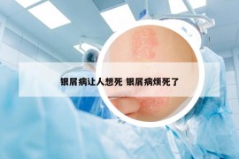 銀屑病讓人想死 銀屑病煩死了