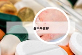 射干牛皮癬
