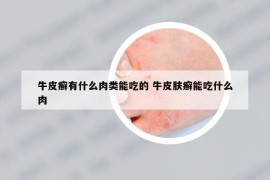 牛皮癬有什么肉類能吃的 牛皮膚癬能吃什么肉