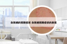 白斑病的初期癥狀 白斑病初期癥狀的表現(xiàn)
