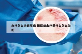 水療怎么治銀屑病 銀屑病水療是什么怎么做的