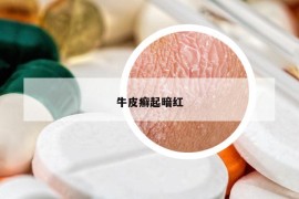 牛皮癬起暗紅