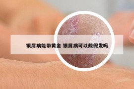 銀屑病能帶黃金 銀屑病可以戴假發(fā)嗎