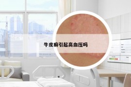 牛皮癬引起高血壓嗎